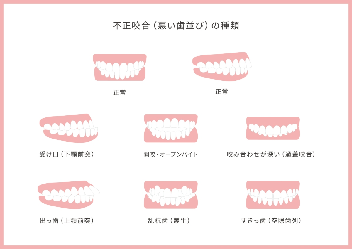 悪い歯並びの一覧表
